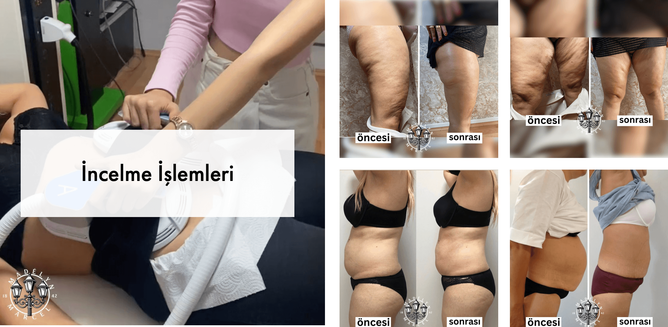 Body Contouring