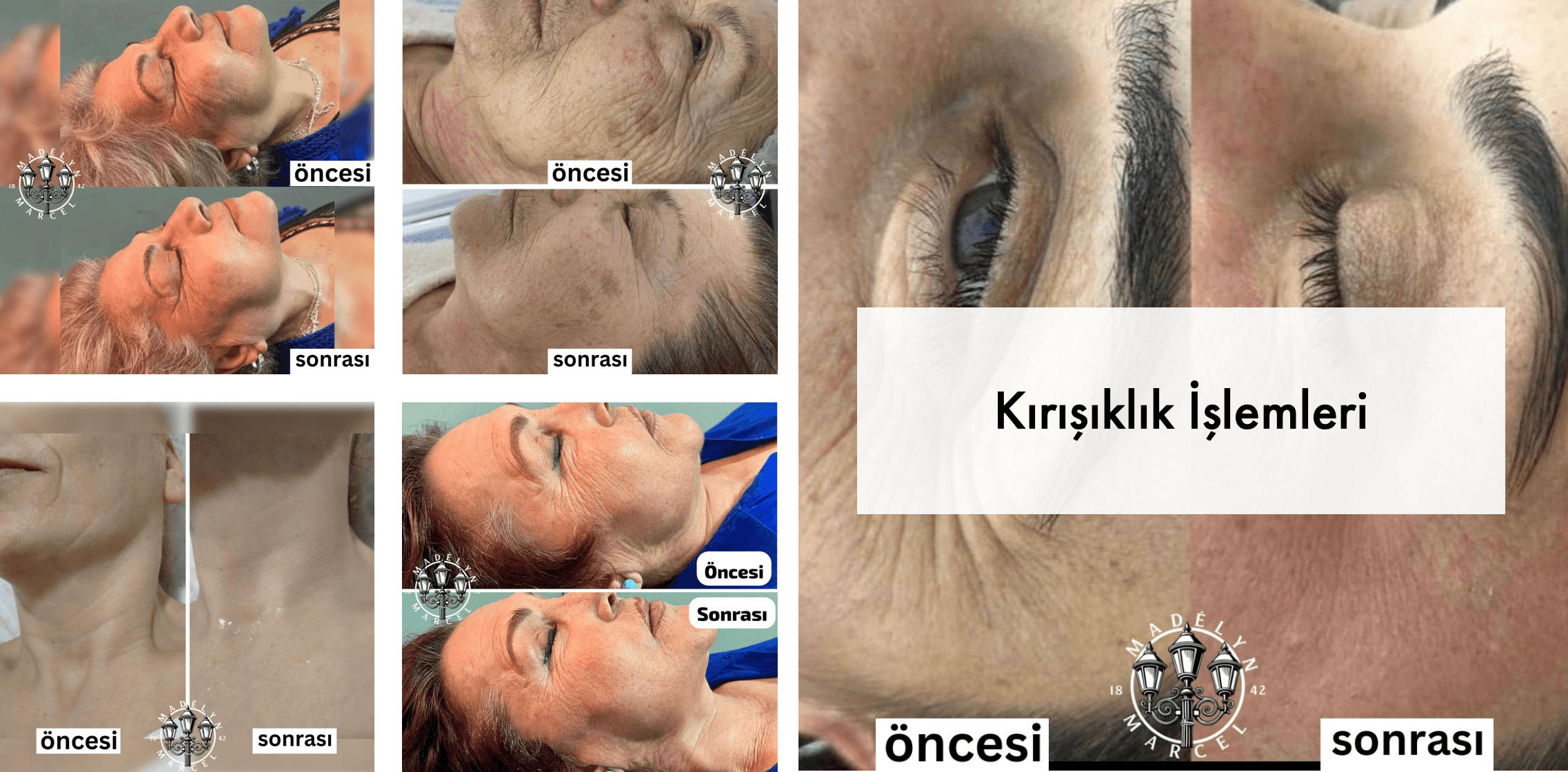 Anti-Wrinkle Treatments
