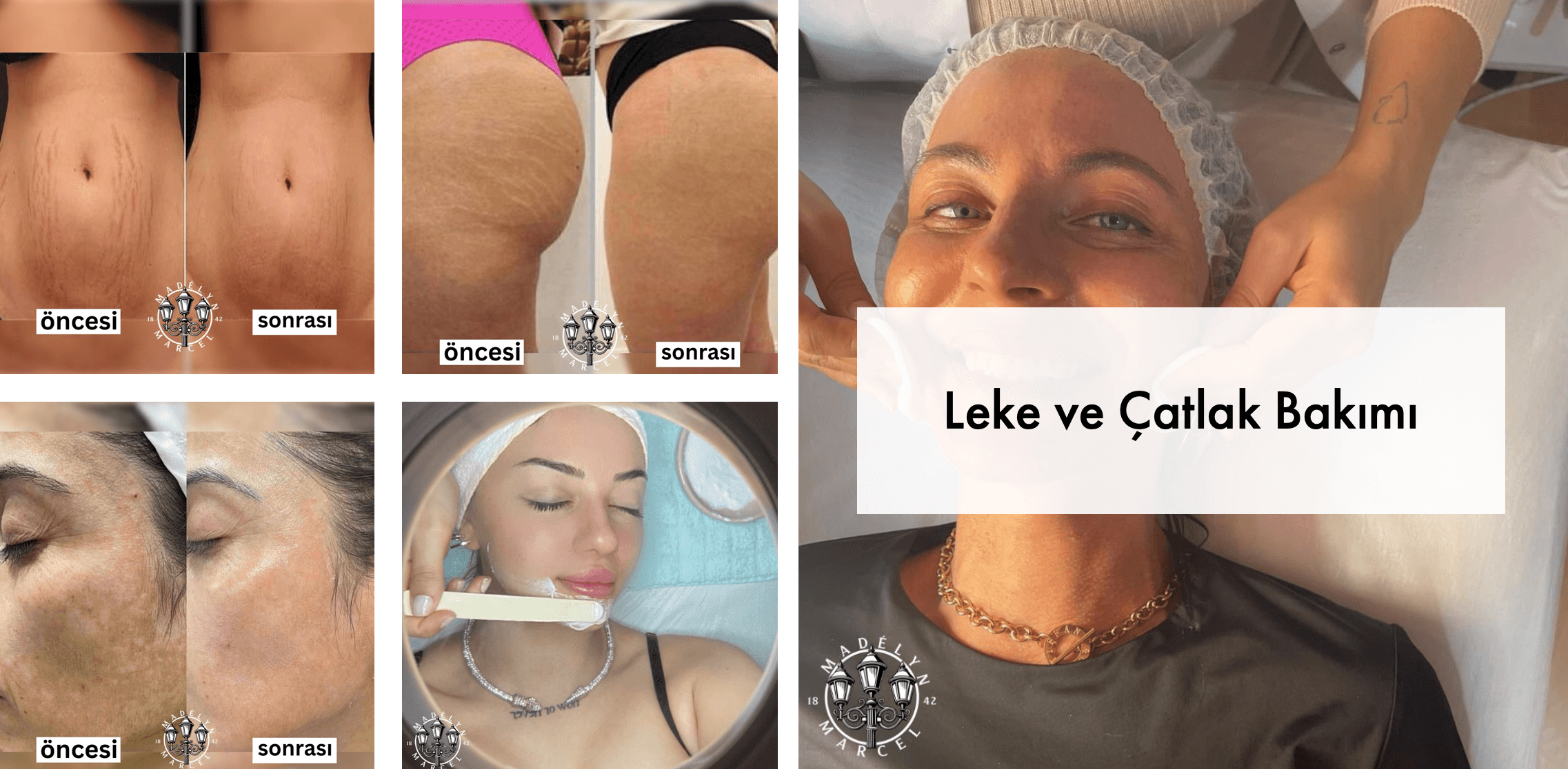 Pigmentation & Stretch Marks